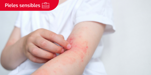 Niño con picor e irritación en el brazo debido a la piel atópica. Se lee el texto “Pieles sensibles” en un recuadro. Niño con picor e irritación en el brazo debido a la piel atópica. Se lee el texto “Pieles sensibles” en un recuadro.